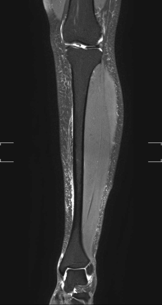 A tibia MRI